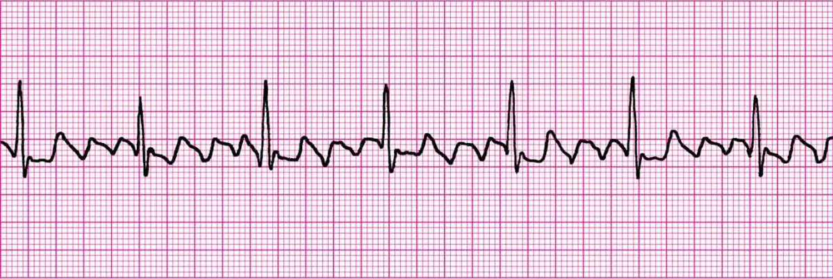 Mi az atrial flutter?